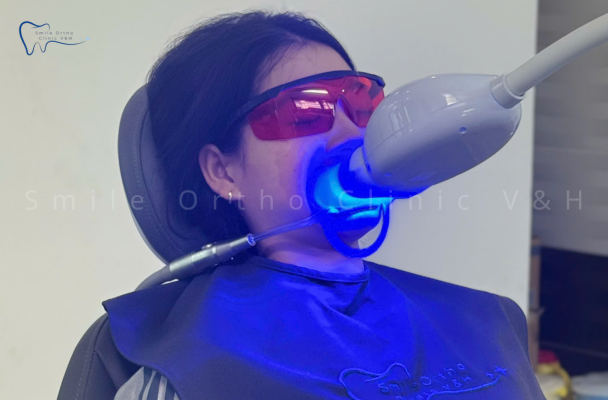 TẨY TRẮNG RĂNG